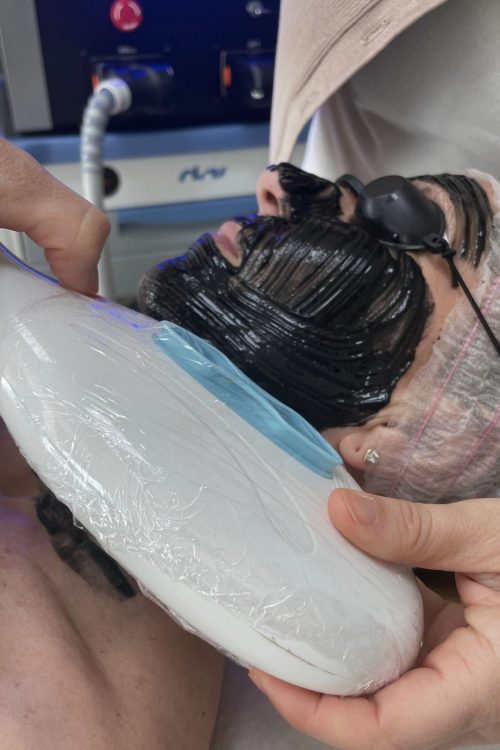 fotorejuvenecimiento03